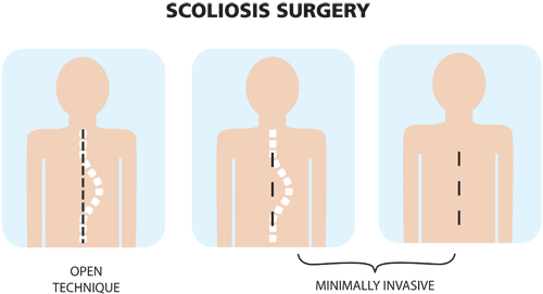 minimally invasive scoliosis surgery texas, louisiana, arkansas
