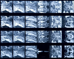 angiogram