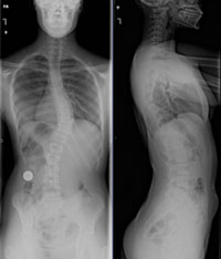 before mini scoliosis surgery xrays, back pain Austin, neck pain Austin, spine surgery Austin, spine care Austin, spine surgeon Austin, Spine surgeon second opinion Austin Texas, Scoliosis surgery Austin Texas, Texas Spine and Scoliosis, Minimally invasive Scoliosis surgery Austin Texas, Scoliosis second opinion Austin Texas, Flatback syndrome Austin Texas, Second opinion for spine surgery Austin Texas, Laser spine surgery Austin Texas, Minimally invasive spine surgery Austin Texas, Home remedies for back pain Austin Texas, Herniated disc Austin Texas, Non-surgical treatment options for back pain Austin Texas, Artificial disc replacement neck Austin Texas, Artificial disc replacement back Austin Texas, Clinical Outcomes for spine Austin Texas, Case rates for spine surgery Austin Texas