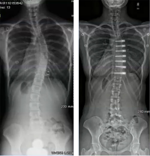 Texas Spine & Scoliosis