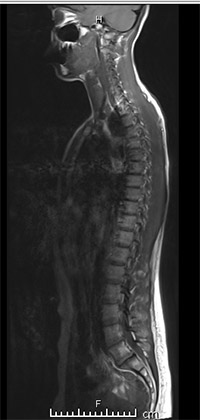 injection therapy, nonsurgical relief from spine pain, herniated disc