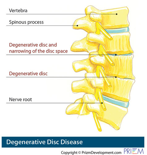 Degenerative Disc Disease
