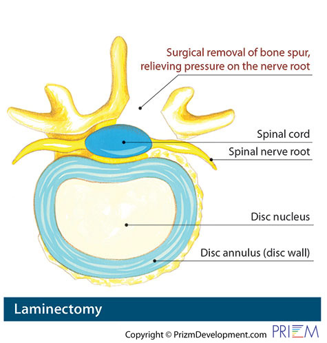 Laminectomy