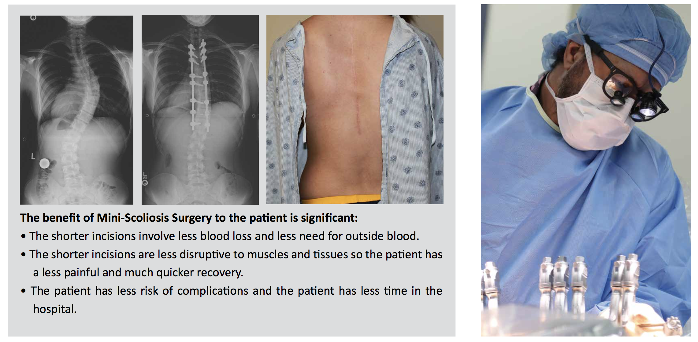 Operate Now: Scoliosis Surgery 