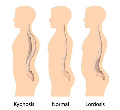 Can Bad Posture Cause Scoliosis?