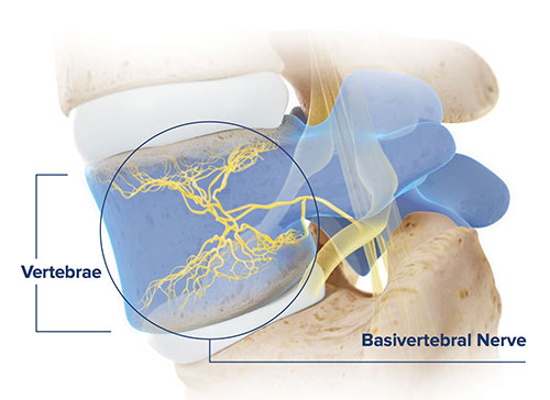 Intracept Procedure  Texas Spine and Scoliosis